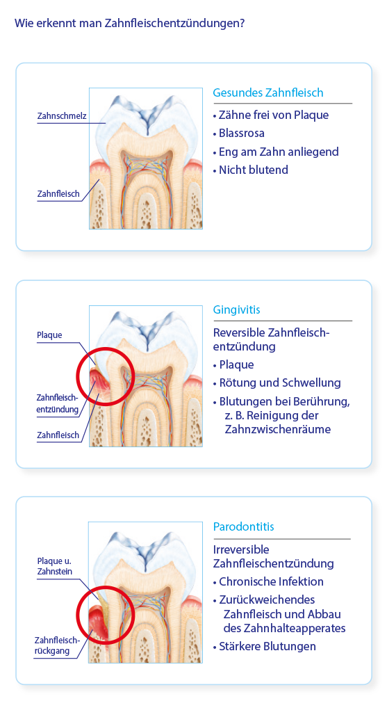 Gingivitis & Parodontitis