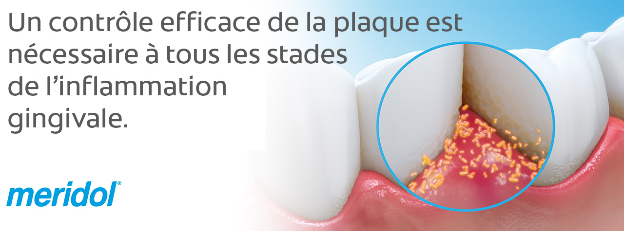 Un contrôle efficace de la plaque est nécessaire à tous les stades de l’inflammation gingivale.