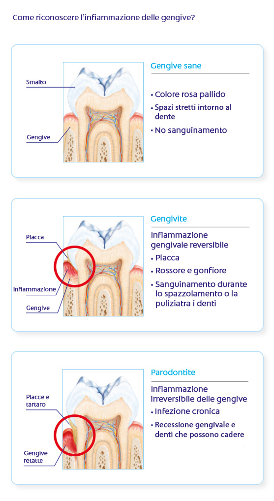 Gengivite e parodontite